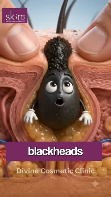 Blackheads ko sirf squeeze karna solution nahi hai! 😬

Blackheads are clogged pores that can make y