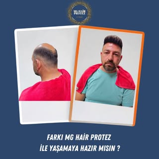 MG HAİR PROTEZ İle Öncesi/Sonrası 💎
