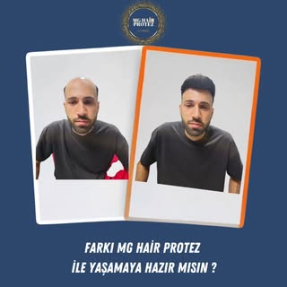 MG HAİR PROTEZ İle Öncesi/Sonrası 💎
