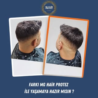 MG HAİR PROTEZ SAÇ UYGULAMAMIZ 💎