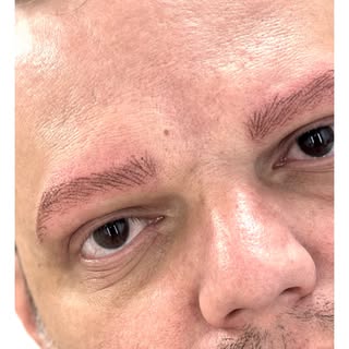 Dermopigmentazione sopraccigliare su alopecia maschile 

Il cliente presentava alopecia pressoché to