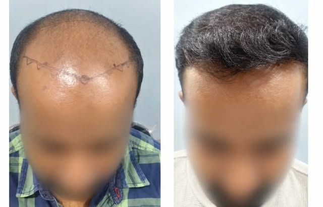 Sometimes, a small change can bring back a big part of your confidence. ✨
💥A new hairline.
💥A full