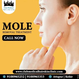 * Mole Removal Treatment @Clubmedical
* Start's @999/-*
* Book Your Consultation Today!
* Visit Our 