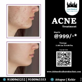 * Acne Treatment @Clubmedical
* Start's @999/-*
* Book Your Consultation Today!
* Visit Our Clinic @