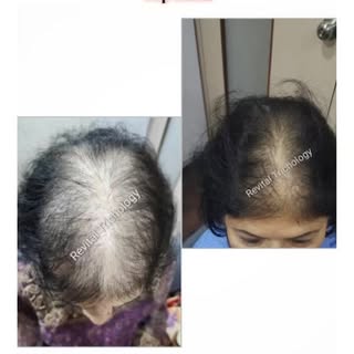 A 48 years old female, entered the cabin with her scalp covered with the scarf. She spoke in a very 