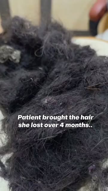 She brought us the hair she had collected over 4 months but excessive hair shedding is not always ju
