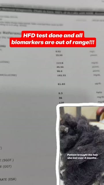 In our previous Reel, we showed the amount of hair our patient had been losing over a period of 4 mo