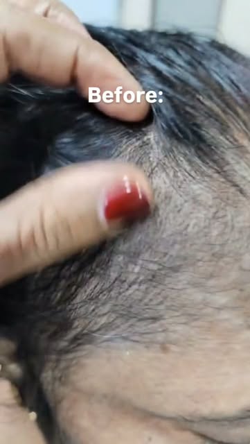 Hair thinning doesn’t always mean the hair follicles are gone. 👀

What looks like severe hair loss 
