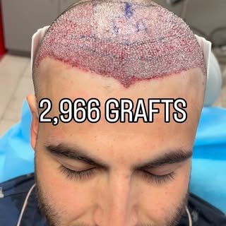2,966 grafts. One carefully designed plan.

Hair restoration isn’t just about adding hair. It’s abou