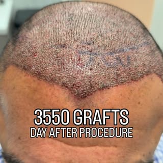 3,550 grafts. One day later.

This is the immediate transformation following a 3,550 graft FUE hair 