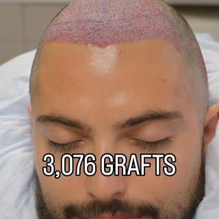 3,076 grafts. One procedure. A completely new frame for the face.

Hair restoration isn’t just about