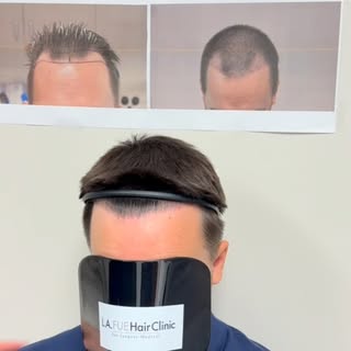 Call for your FREE Consultation 
+ 1 (626) 222 - 8888

One year later. Over 3,000 grafts. And there’