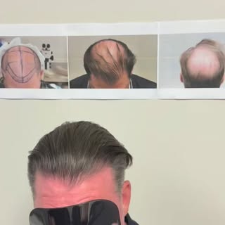 Two procedures. One transformation. And he’s still not done growing.

Johnny first came to LA FUE Ha