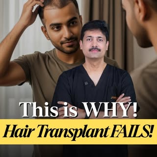 Hair transplants fail 30% of the time mostly poor post-op care. Grafts die from sun, sweat, touching