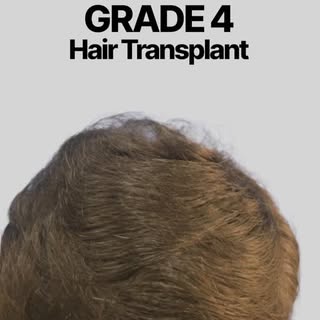 Grade 4 hair transplant reels should highlight a major transformation, because the hair loss is alre