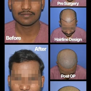 Grade 5 hair transplant before/after reels should show a strong transformation because the hair loss