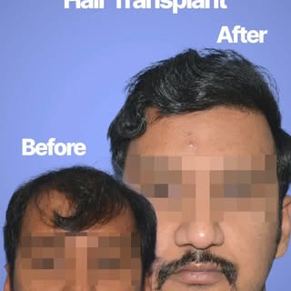 Grade 6 hair transplant before/after reels should show one of the most dramatic transformations, bec