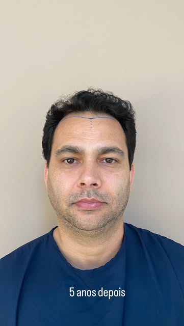 Paciente retorna 5 anos depois para mostrar esse resultado 👏🏼👏🏼🤩#transplantecapilar #hairtransp