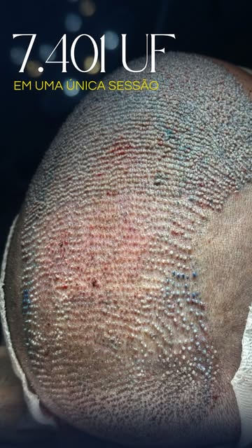 7.401 folículos em uma única sessão.

Aos 54 anos, este paciente de Betim (MG) realizou seu transpla
