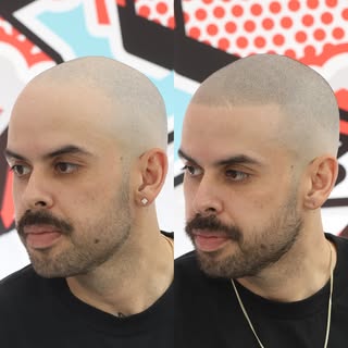 Smp is a total game changer every time!!! This is after the second session. Hair loss stands no chan