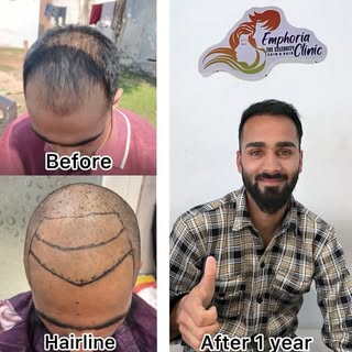 Hair Transplant Result @emphoria_thecelebrity_skinhair. #hair #hairtransformation #hairtransplant #h