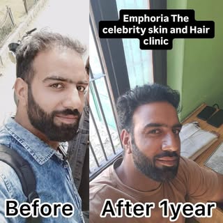 Hair Transplant Result @emphoria_thecelebrity_skinhair #emphoriaclinic #hair #hairtransformation #ha
