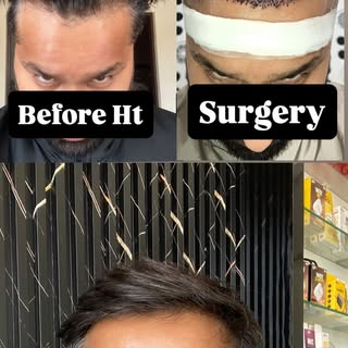 Hair Transplant Result @emphoria_thecelebrity_skinhair #hair #hairtransformation #hairtransplant #ba