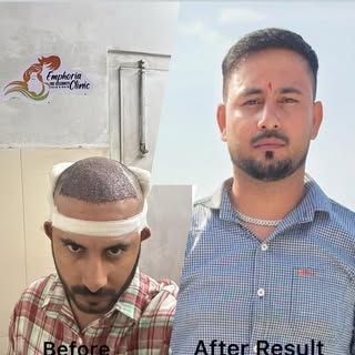 Hair Transplant Result @emphoria_thecelebrity_skinhair. #hair #hairtransplant #hairtransformation