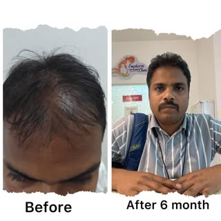 GFC Result @emphoria_thecelebrity_skinhair #gfc #gfctreatment #gfcresults #prp #prpresults