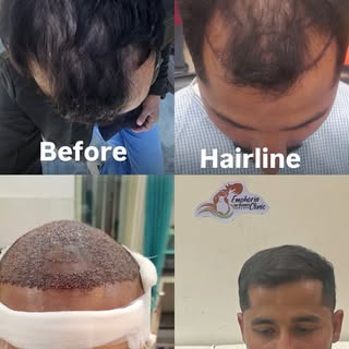 Hair Transplant Result @emphoria_thecelebrity_skinhair. #hair #hairtransformation #hairtransplant