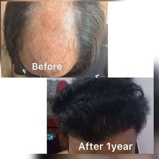 DHI Hair Transplant @emphoria_thecelebrity_skinhair #hair #dhihairtransplant #hairtransplant #prp