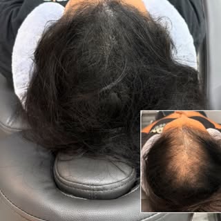 Blonde. Brunette. Redhead. Silver.
At NuHair Ink, we customize every Scalp Micropigmentation treatme