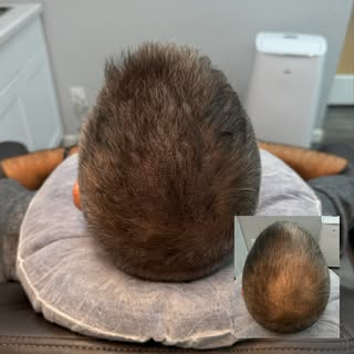 Scalp Micropigmentation Density Treatment

A density treatment is one of the most effective ways to 