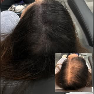 Scalp Micropigmentation Density Treatment

A density treatment is one of the most effective ways to 