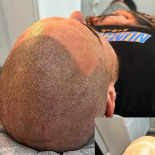 Hair loss does not define you.
Confidence does.

At NuHair Ink, we use advanced scalp micropigmentat
