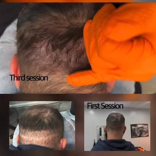 At NuHair Ink, we use advanced scalp micropigmentation to create the look of real density, clean hai