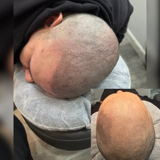 At NuHair Ink, we use advanced scalp micropigmentation to create the look of real density, clean hai