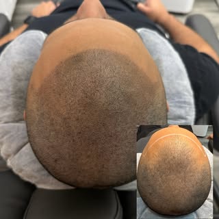 * Hairline brought back. Confidence restored.

This is what Scalp Micropigmentation can do. We build
