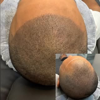 Hair Loss? We can help!
Extremely affordable
Permanent Results ##scalpmicropigmentation #sacramento