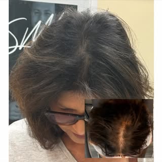 A natural-looking hairline starts with the right detail.

Scalp Micropigmentation is designed to cre