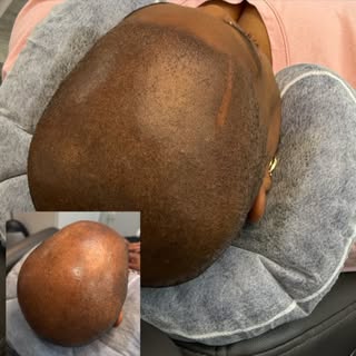 A natural-looking hairline starts with the right detail.

Scalp Micropigmentation is designed to cre