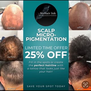 Ready to stop hiding thinning hair or a receding hairline?

Scalp micropigmentation creates the appe