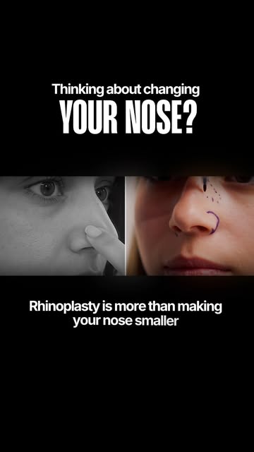 Thinking about changing your nose? 👃✨

Rhinoplasty is about more than making your nose smaller. It’