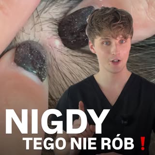 NIGDY TEGO NIE RÓB❗️wyciskanie zmian skórnych szczególnie na skórze głowy to zły pomysł. #pielegnacj