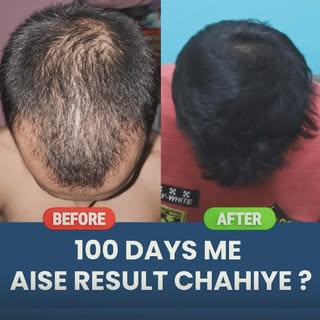 100% hair regrowth in 100 days ! Real story of Zuber !!!