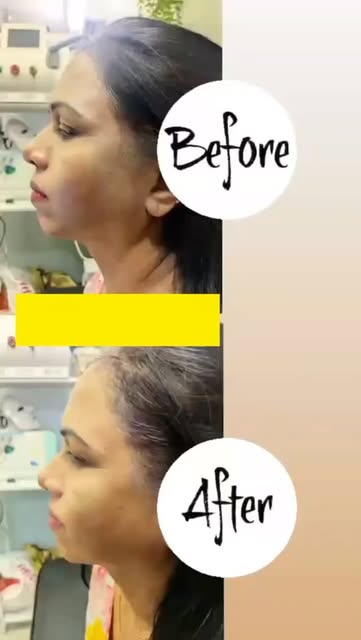 Ageing ko bolo bye-bye, naturally! 💫”

HIFU skin ko naturally tighten karta hai aur collagen boost 