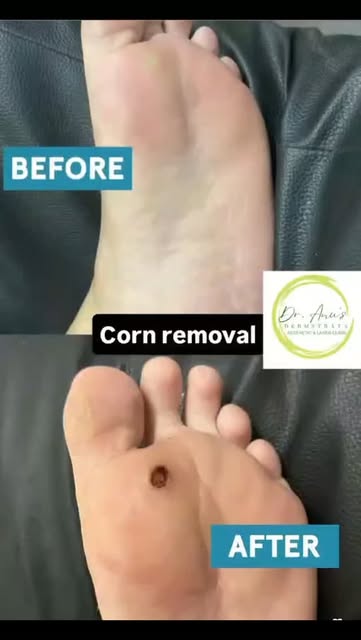 That stubborn corn, tiny milia, or bothersome mole doesn’t always need to stay forever. ✨
At Dr Anu’