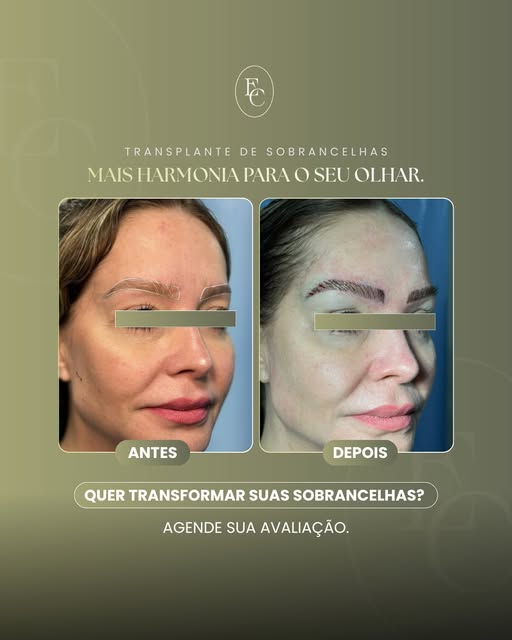 O transplante de sobrancelhas é a solução para quem deseja corrigir falhas, recuperar a densidade do
