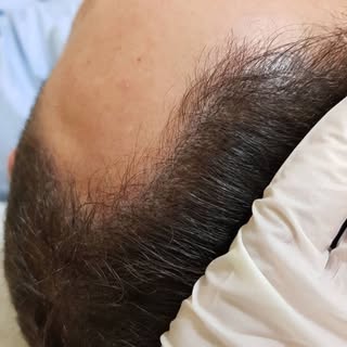 Doğal, dolgun ve bakımlı bir görünüm ✨
Saç pigmentasyonu ile seyrek alanlara veda, özgüvene merhaba.