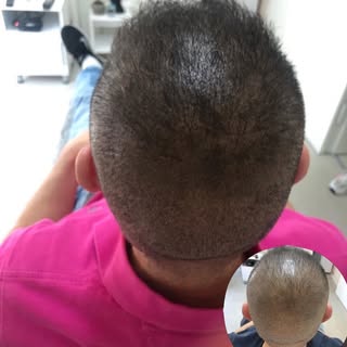 Üst bölgede yoğun seyrelme yaşayanlar için net çözüm 👇

Saç pigmentasyonu ile başın üst kısmı tamam